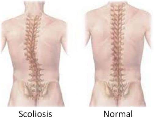 physiotherapy, treat scoliosis, Scoliosis, physio near me, adelaide physio therapy,