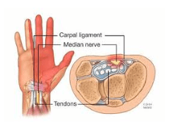 carpal tunnel relief