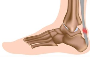 Tendinopathy, Tendinopathies, Physiotherapist, Physio near me, Rehabilitation, Tendinopathy rehab, Symptoms, Tendinopathy symptoms