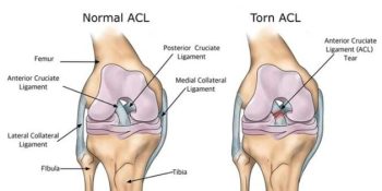 An-ACL-Injury
